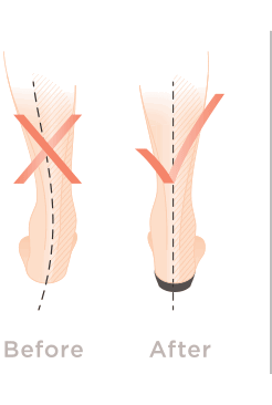 Illustration of how FMT Technology helps reduce over-pronation and pain from plantar fasciitis