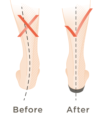 Illustration of how FMT technology helps reduce over-pronation and pain from plantar fasciitis